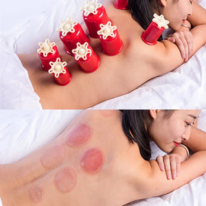 Traditional Hand-twist Cupping Massage